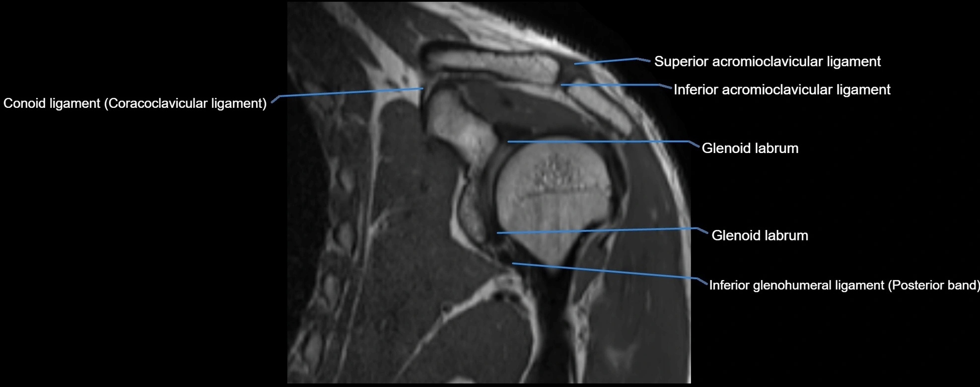 shoulder ligments coronal  cross sectional anatomy 3T MRI AI enhanced radiology image -img-00001-00026.webp